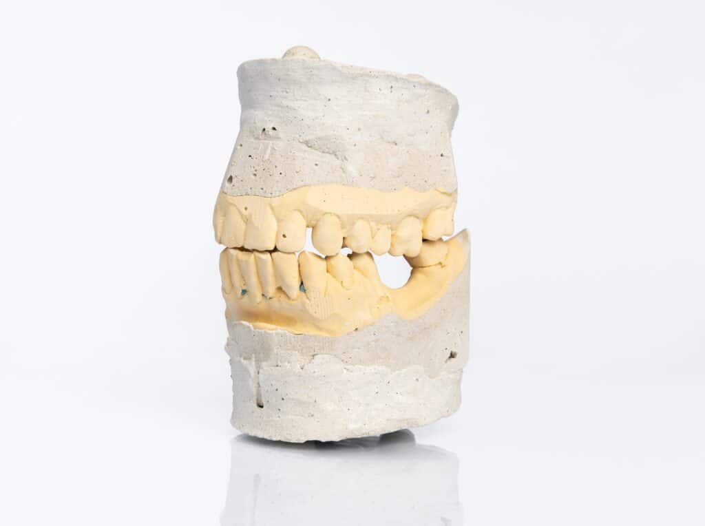 Plaster dental model showing a gap left by a missing tooth
