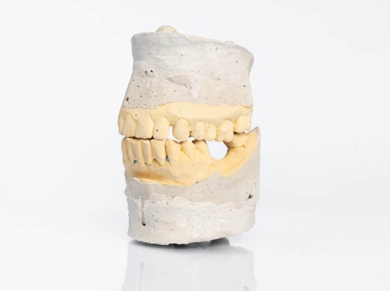 What happens after a tooth is lost?